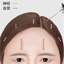 手术方法2