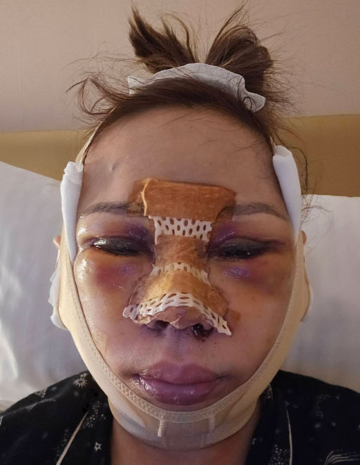 Janet after surgery
