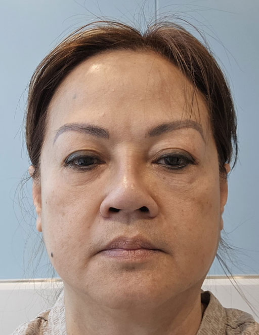 Janet before surgery