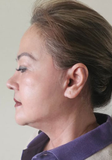 Janet 3 months post-op, left profile