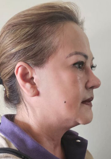 Janet 3 months post-op, right profile
