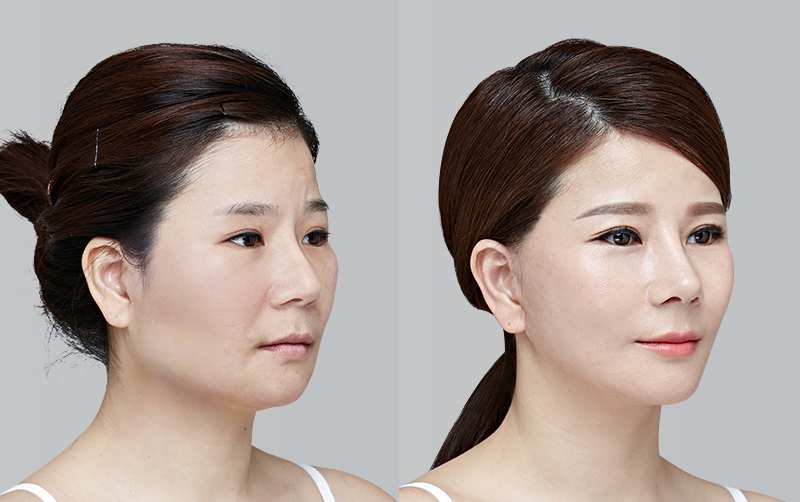 NON-INCISIONAL DOUBLE EYELID SURGERY before and 6 months after - 45-degree view