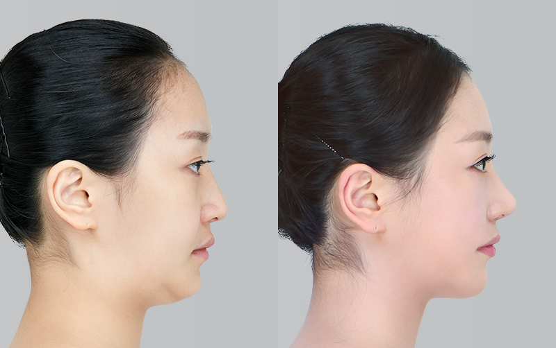 FACIAL CONTOURING (CHEEKBONE REDUCTION+JAW ANGLE REDUCTION+GENIOPLASTY) before and 6 months after - profile view