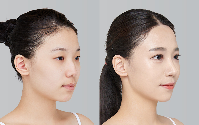 RHINOPLASTY before and 6 months after - 45-degree view