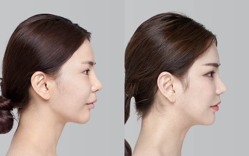 RHINOPLASTY before and 6 months after - profile view