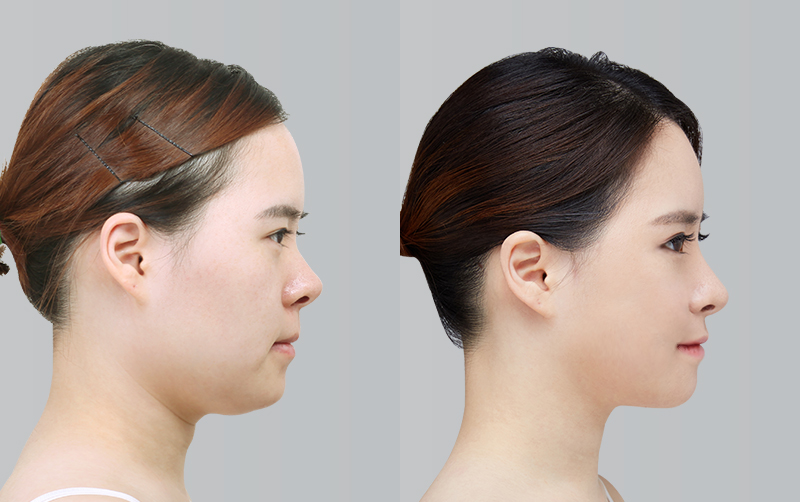LATERAL CANTHOPLASTY+INCISIONAL DOUBLE EYELID SURGERY+PTOSIS CORRECTION before and 6 months after - profile view