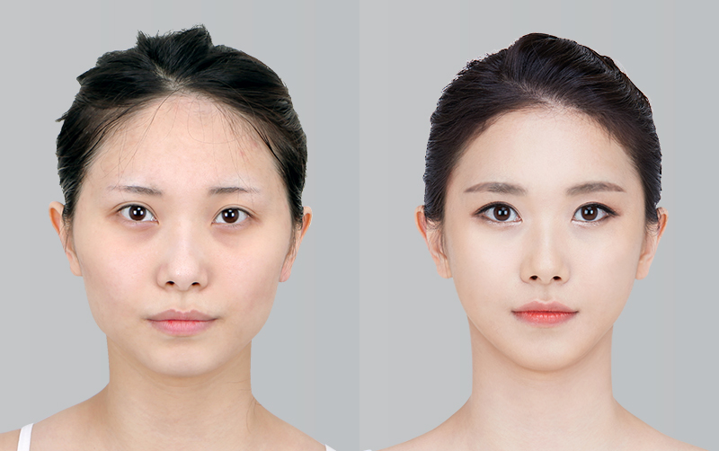 FACIAL CONTOURING (CHEEKBONE REDUCTION+JAW ANGLE REDUCTION+GENIOPLASTY) before and 6 months after - front view