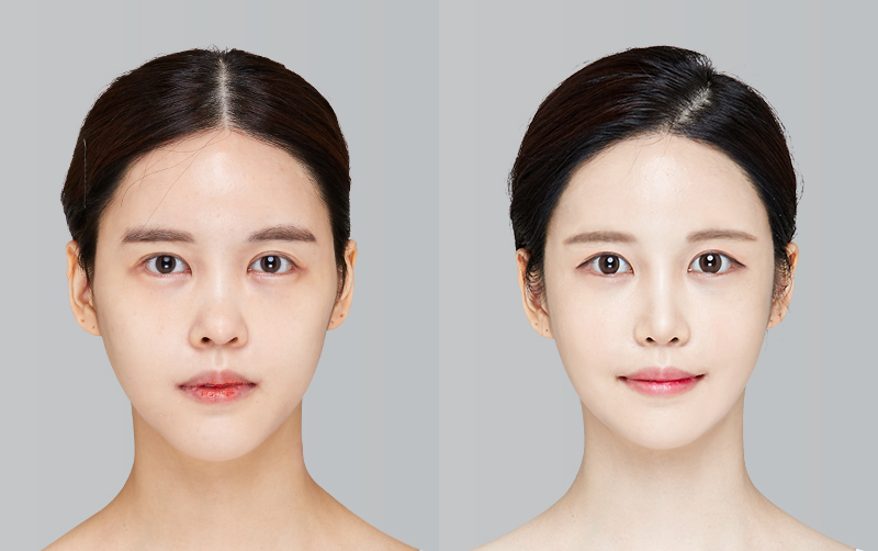 FACIAL CONTOURING (CHEEKBONE REDUCTION+JAW ANGLE REDUCTION+GENIOPLASTY+CHIN RETRACTION) before and 6 months after - front view