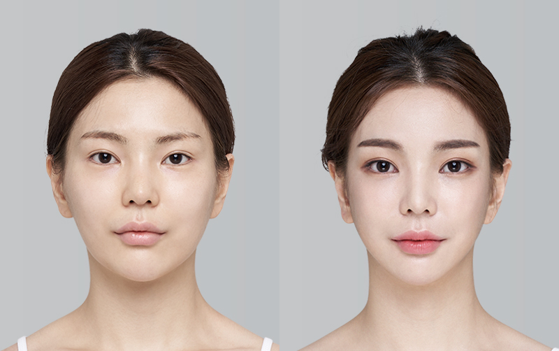 RHINOPLASTY before and 6 months after - front view