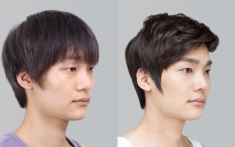RHINOPLASTY before and 6 months after - 45-degree view