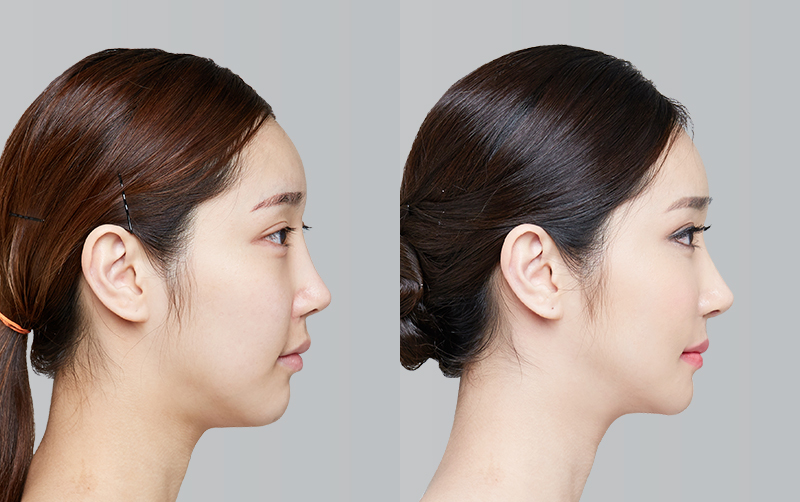 FACIAL CONTOURING (CHEEKBONE REDUCTION+JAW ANGLE REDUCTION+GENIOPLASTY) before and 6 months after - profile view