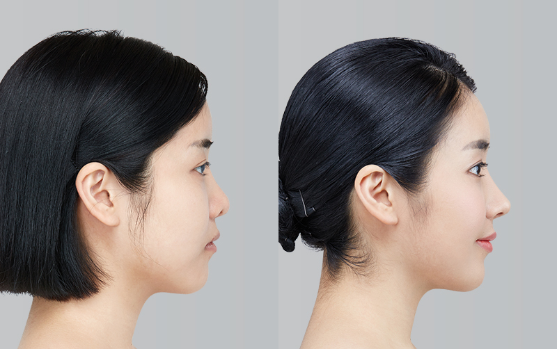 RHINOPLASTY before and 6 months after - profile view