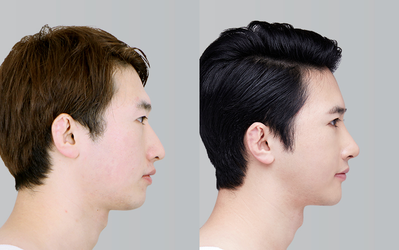 RHINOPLASTY before and 6 months after - profile view