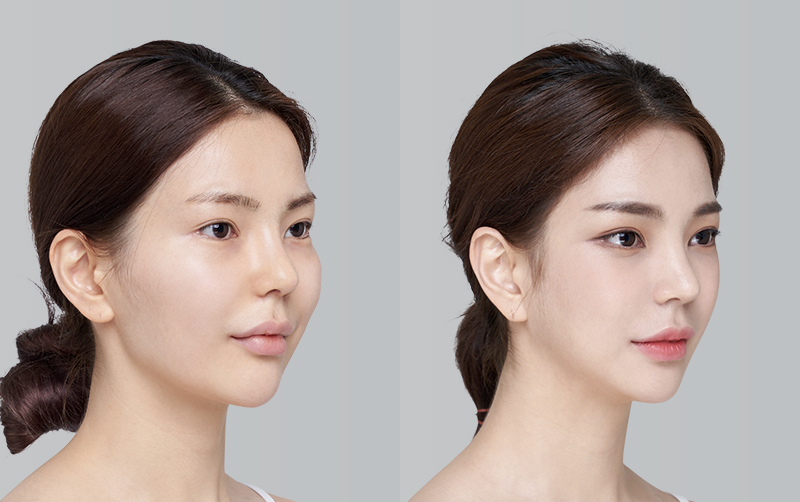 FACIAL CONTOURING (CHEEKBONE REDUCTION+JAW ANGLE REDUCTION+GENIOPLASTY) before and 6 months after - 45-degree view