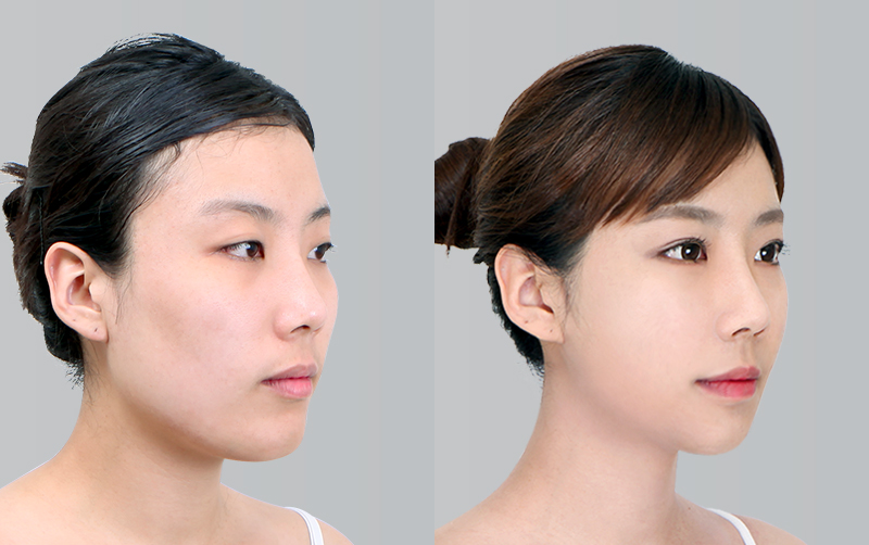 FACIAL CONTOURING (CHEEKBONE REDUCTION+JAW ANGLE REDUCTION+GENIOPLASTY) before and 6 months after - 45-degree view