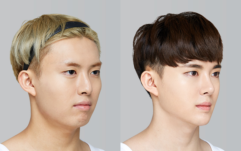 RHINOPLASTY before and 6 months after - 45-degree view