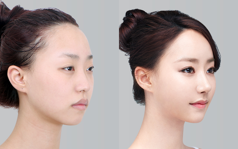 RHINOPLASTY before and 6 months after - 45-degree view