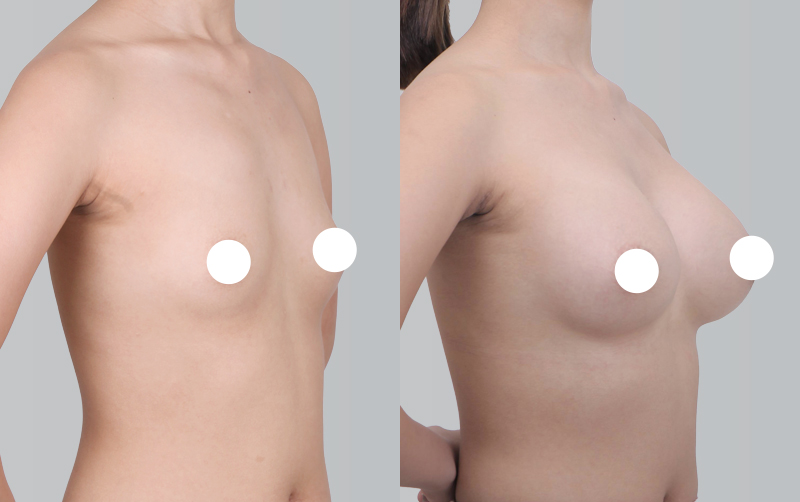 BREAST AUGMENTATION before and 6 months after - 45-degree view