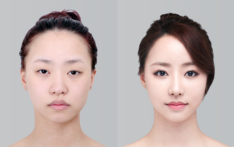 RHINOPLASTY before and 6 months after - front view