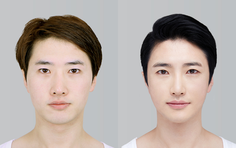 RHINOPLASTY before and 6 months after - front view