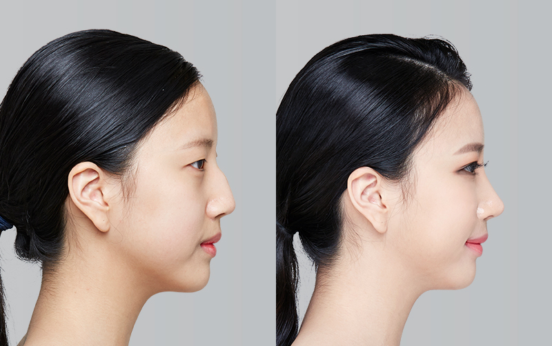 FACIAL CONTOURING (CHEEKBONE REDUCTION+JAW ANGLE REDUCTION+GENIOPLASTY) before and 6 months after - profile view