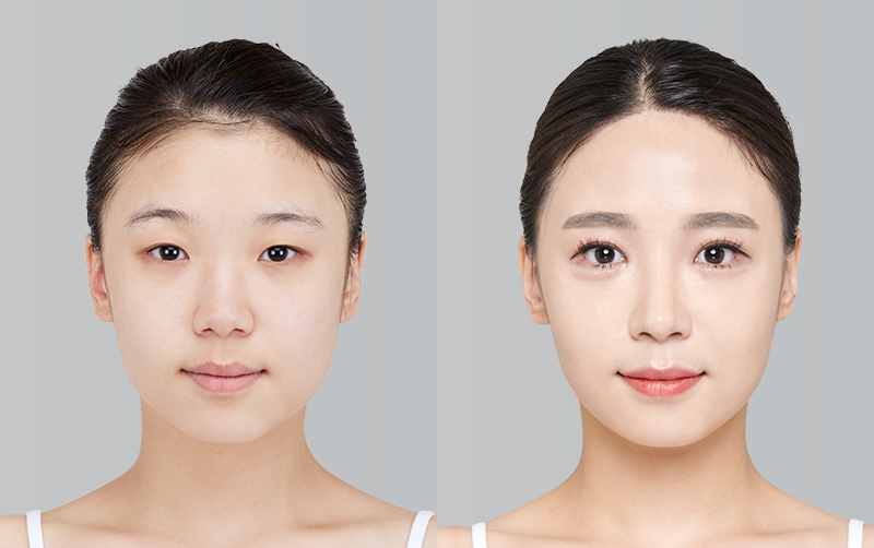 RHINOPLASTY before and 6 months after - front view