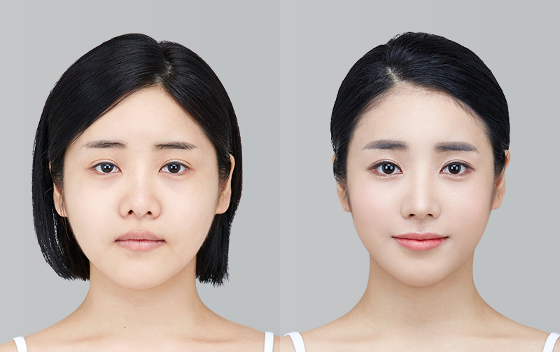 RHINOPLASTY before and 6 months after - front view