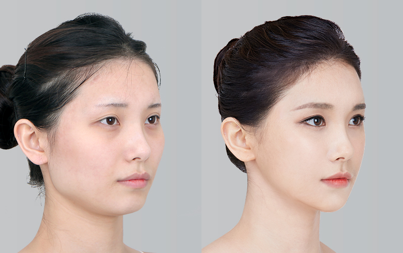 FACIAL CONTOURING (CHEEKBONE REDUCTION+JAW ANGLE REDUCTION+GENIOPLASTY) before and 6 months after - 45-degree view