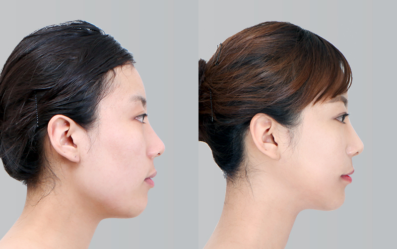 FACIAL CONTOURING (CHEEKBONE REDUCTION+JAW ANGLE REDUCTION+GENIOPLASTY) before and 6 months after - profile view