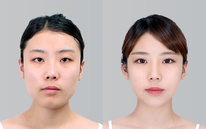 FACIAL CONTOURING (CHEEKBONE REDUCTION+JAW ANGLE REDUCTION+GENIOPLASTY) before and 6 months after - front view