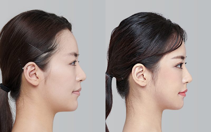 NON-INCISIONAL DOUBLE EYELID SURGERY before and 6 months after - profile view