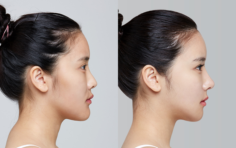 FACIAL CONTOURING (CHEEKBONE REDUCTION+JAW ANGLE REDUCTION+GENIOPLASTY+CHIN RETRACTION) before and 6 months after - profile view