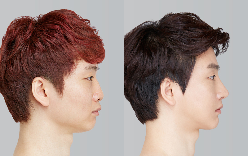 FACIAL CONTOURING (CHEEKBONE REDUCTION+JAW ANGLE REDUCTION+GENIOPLASTY) before and 6 months after - profile view