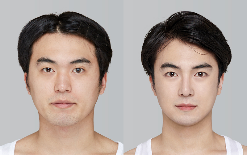 FACIAL CONTOURING (CHEEKBONE REDUCTION+JAW ANGLE REDUCTION+GENIOPLASTY) before and 6 months after - front view