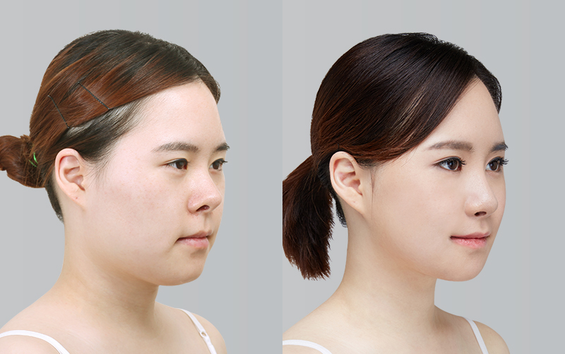 RHINOPLASTY before and 6 months after - 45-degree view