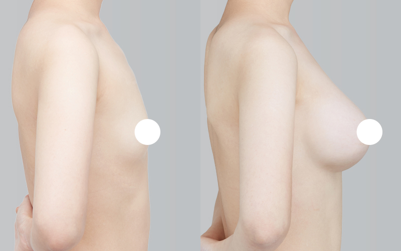 BREAST AUGMENTATION before and 6 months after - profile view