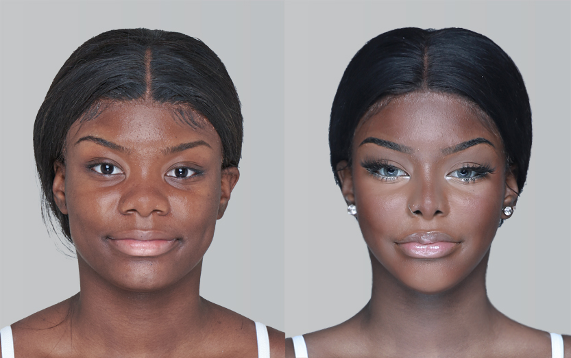 FACIAL CONTOURING (CHEEKBONE REDUCTION+JAW ANGLE REDUCTION+GENIOPLASTY)+SUNKEEN CHEEK CORRECTION before and 6 months after - front view