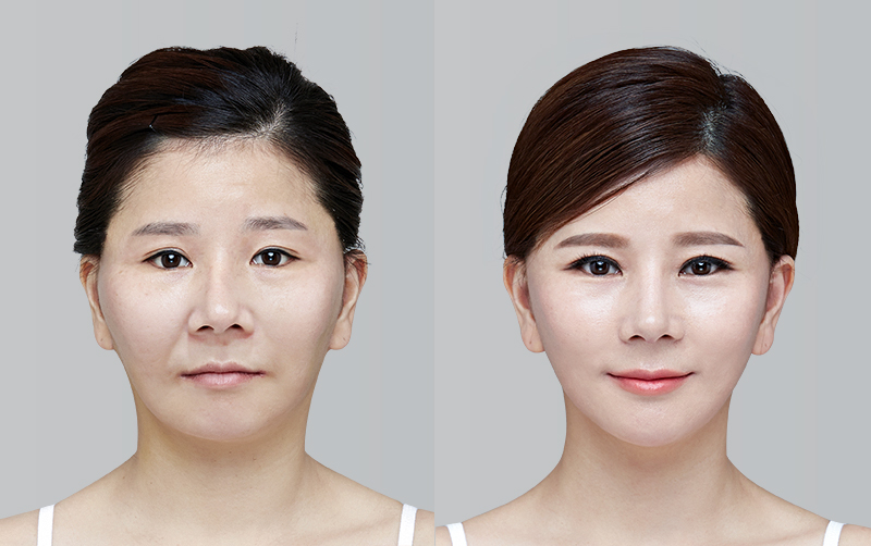 NON-INCISIONAL DOUBLE EYELID SURGERY before and 6 months after - front view