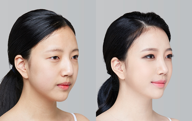 FACIAL CONTOURING (CHEEKBONE REDUCTION+JAW ANGLE REDUCTION+GENIOPLASTY) before and 6 months after - 45-degree view