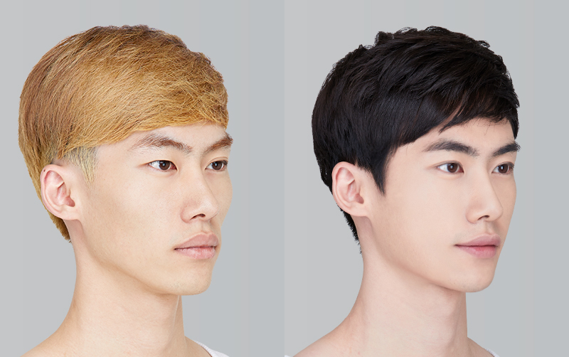 FACIAL CONTOURING (CHEEKBONE REDUCTION+JAW ANGLE REDUCTION+GENIOPLASTY) before and 6 months after - 45-degree view