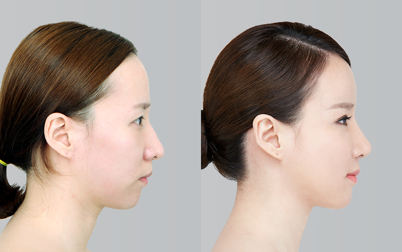 FACIAL CONTOURING (CHEEKBONE REDUCTION+JAW ANGLE REDUCTION+GENIOPLASTY) before and 6 months after - profile view