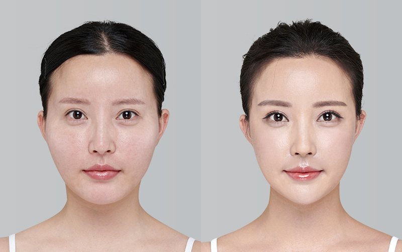 FACIAL CONTOURING (CHEEKBONE REDUCTION+JAW ANGLE REDUCTION) before and 6 months after - front view