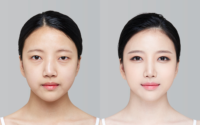 FACIAL CONTOURING (CHEEKBONE REDUCTION+JAW ANGLE REDUCTION+GENIOPLASTY) before and 6 months after - front view
