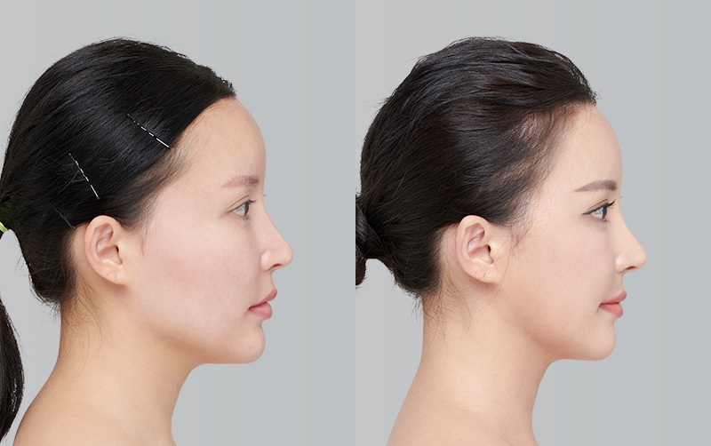 FACIAL CONTOURING (CHEEKBONE REDUCTION+JAW ANGLE REDUCTION) before and 6 months after - profile view