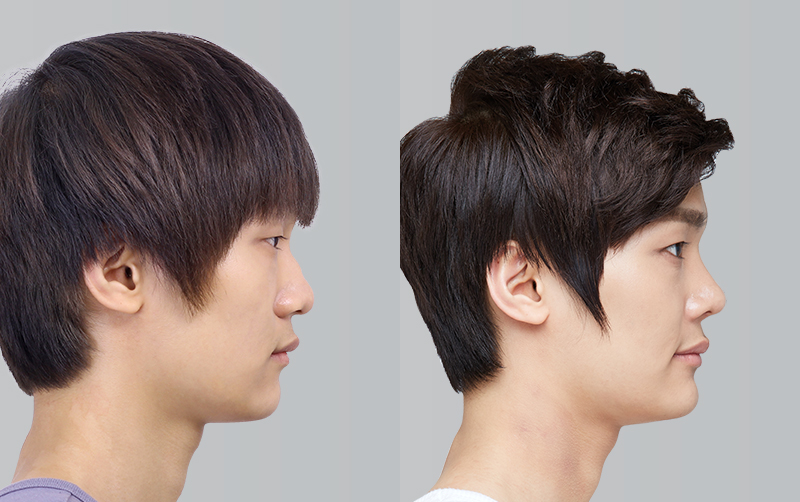 RHINOPLASTY before and 6 months after - profile view