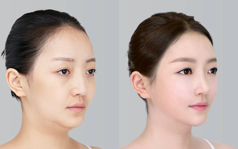 FACIAL CONTOURING (CHEEKBONE REDUCTION+JAW ANGLE REDUCTION+GENIOPLASTY) before and 6 months after - 45-degree view