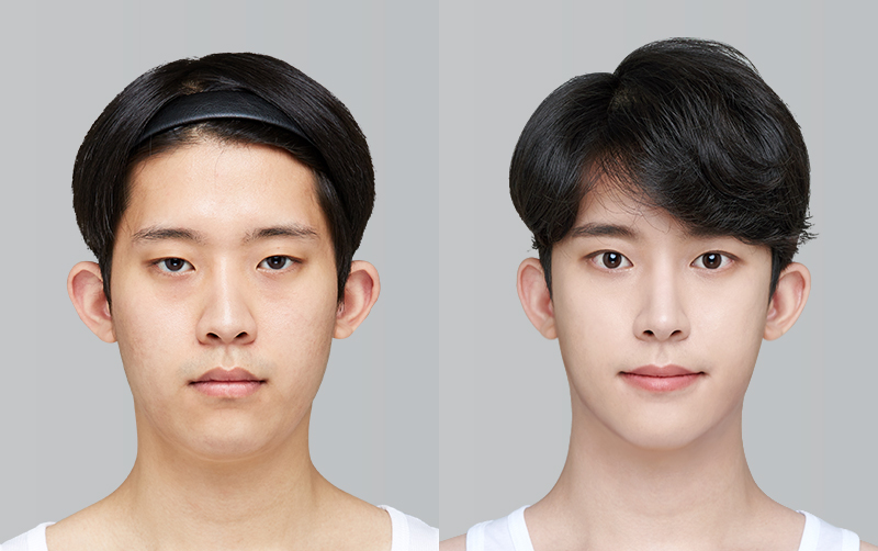 FACIAL CONTOURING (CHEEKBONE REDUCTION+JAW ANGLE REDUCTION+GENIOPLASTY) before and 6 months after - front view