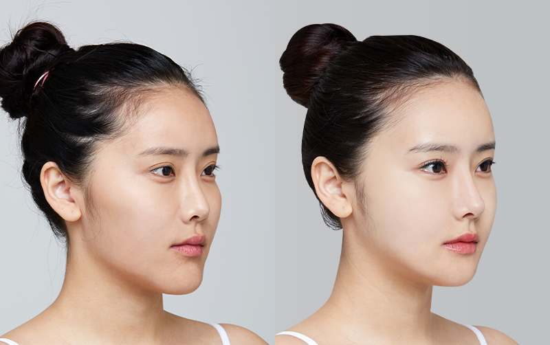 FACIAL CONTOURING (CHEEKBONE REDUCTION+JAW ANGLE REDUCTION+GENIOPLASTY+CHIN RETRACTION) before and 6 months after - 45-degree view