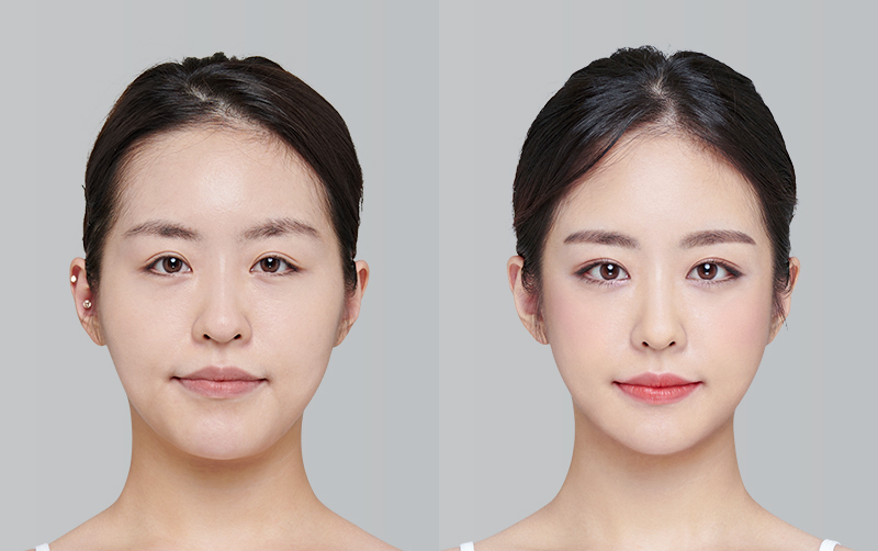 NON-INCISIONAL DOUBLE EYELID SURGERY before and 6 months after - front view