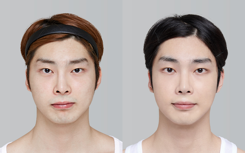 FACIAL CONTOURING (CHEEKBONE REDUCTION+JAW ANGLE REDUCTION+GENIOPLASTY) before and 6 months after - front view